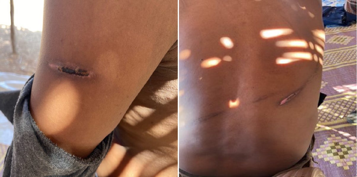 Close up of scars