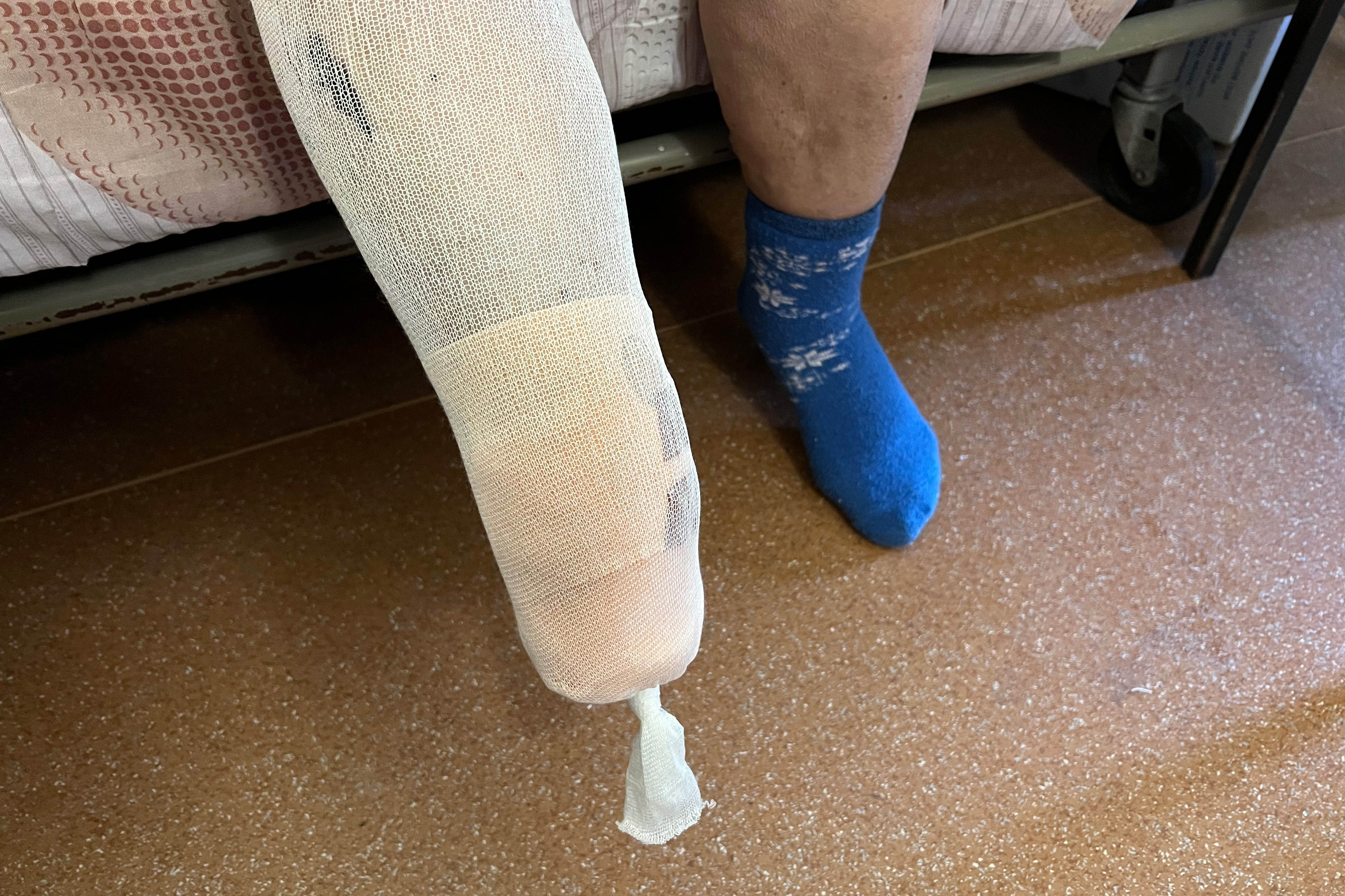 Resident sits on a bed. Picture taken of amputated lower leg. 