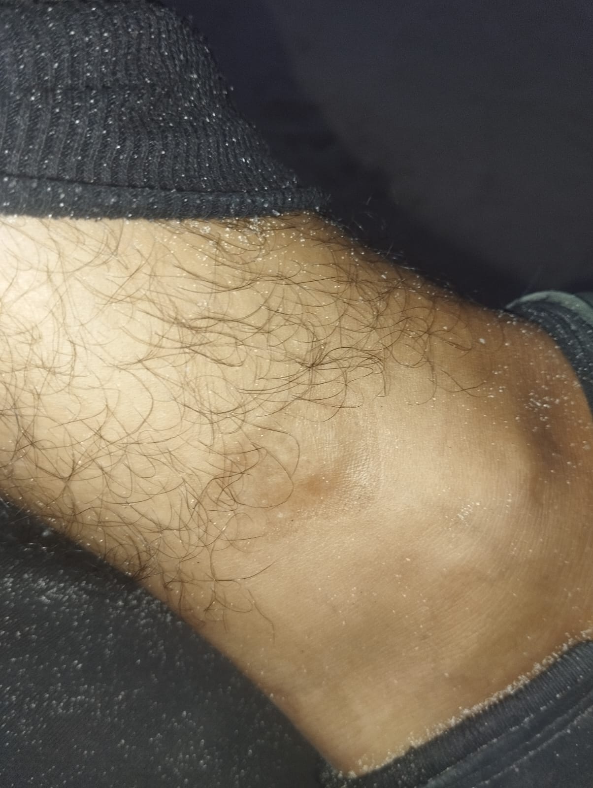 סימנים נראים לעין על קרסולו של וליד ח'לילי, שנגרמו כתוצאה מאיזוק ומחִשמול. התמונה צולמה ב-8 באפריל 2024, בערך, לאחר שח'לילי שוחרר ממעצר בישראל.