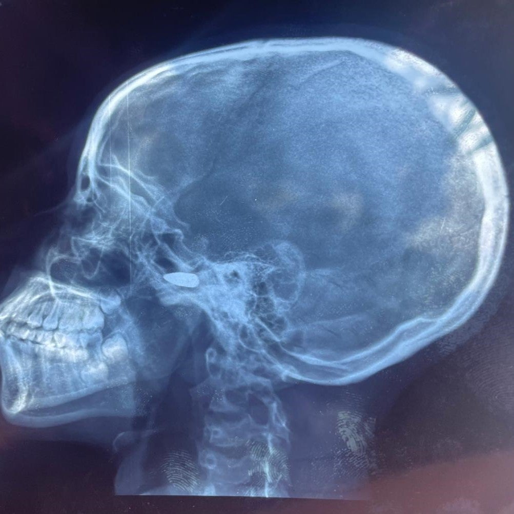 Radiographie d'une fille de 15 ans qui a été touchée à la tête par une balle perdue à Bébédja, au sud du Tchad, le 9 mai 2024, après l'annonce des résultats provisoires de l'election présidentielle au Tchad.