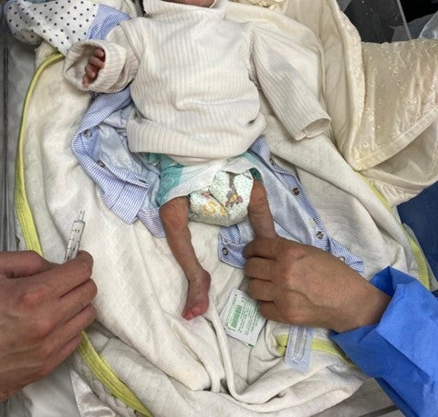 صورة رضيع لديه سوء تغذية وجفاف شديدان في "مستشفى الهلال الإماراتي". 
