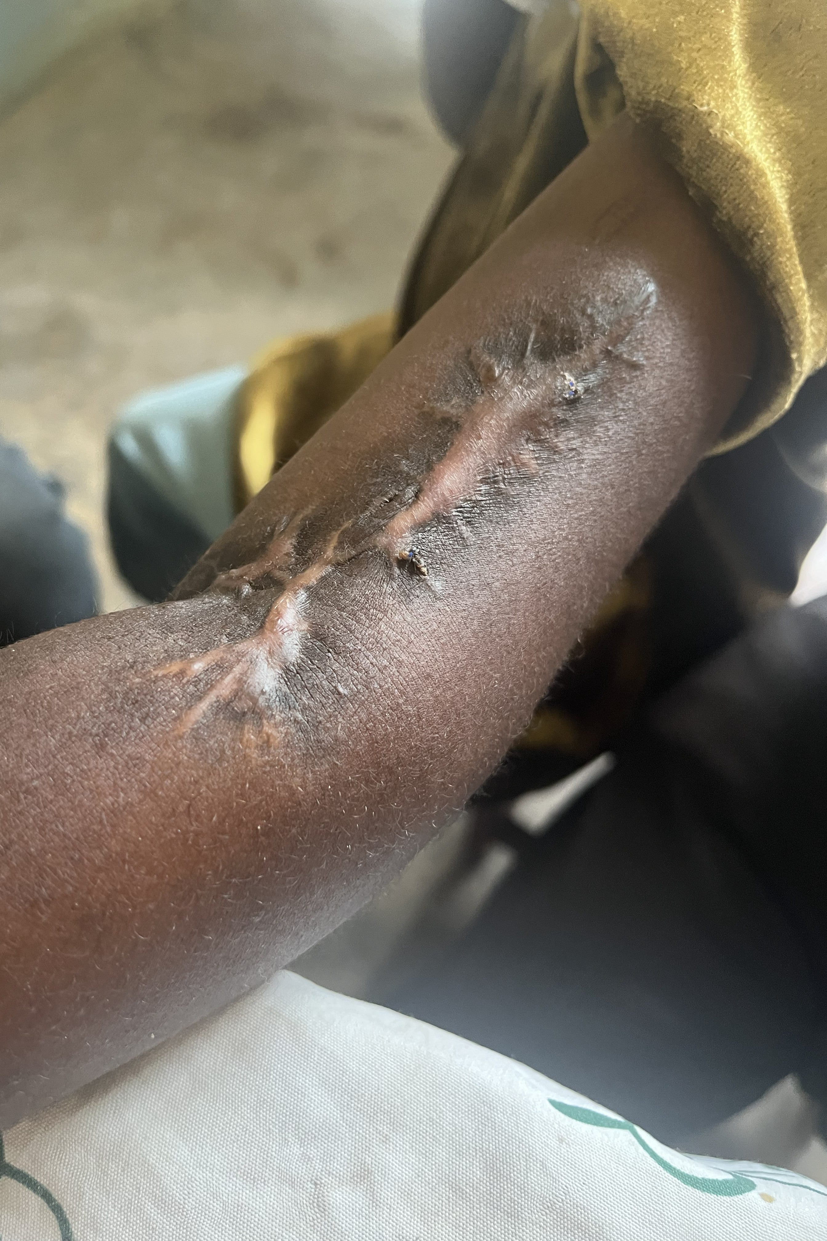 A boy showing the scar on his arm