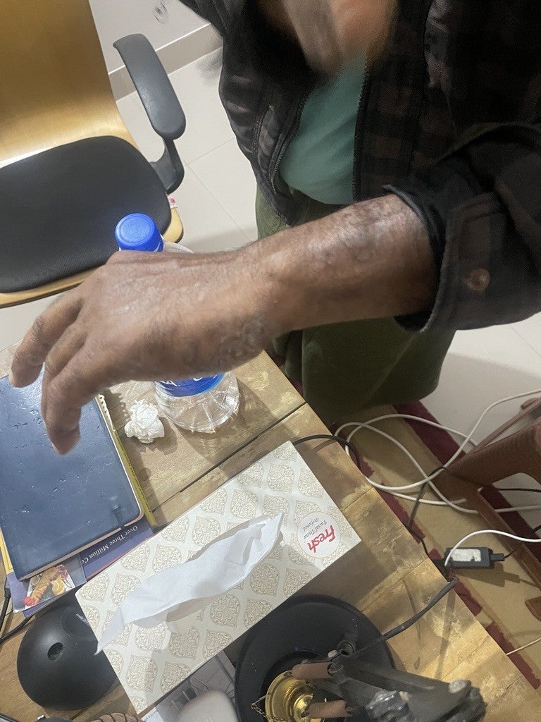 Photograph showing Kefayet Ulla’s injuries taken by a Human Rights Watch researcher in Bangladesh in December 2025. 