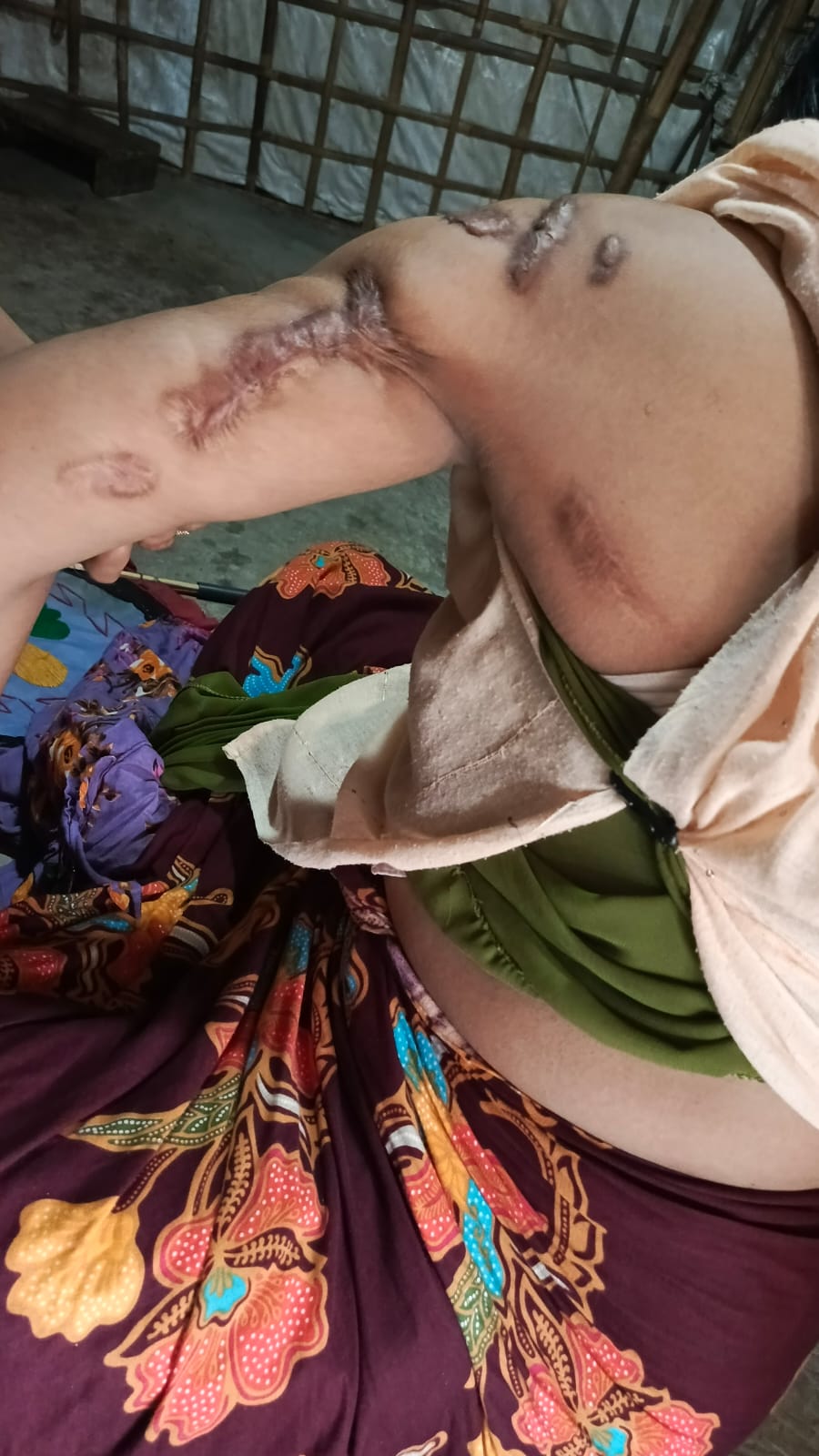 Photograph showing Rashida Hatu’s injuries taken in Cox’s Bazar Rohingya refugee camp, Bangladesh in April 2026. 
