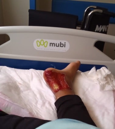 photo of an injured foot