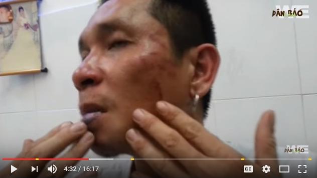 Đỗ Đức Hợp sau khi bị tấn công ở Thành phố Hồ Chí Minh ngày mồng 8 tháng Năm năm 2016. 