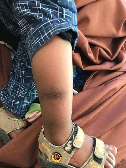 Canug yar oo shan bilood jir ah ayay xabbadi lugta uga dhacday intii uu socday weerarkii Jaamac Dubad. Hooyadii iyo ayeydii ayaa ku dhintay falkaasi, Disembar 2016.
