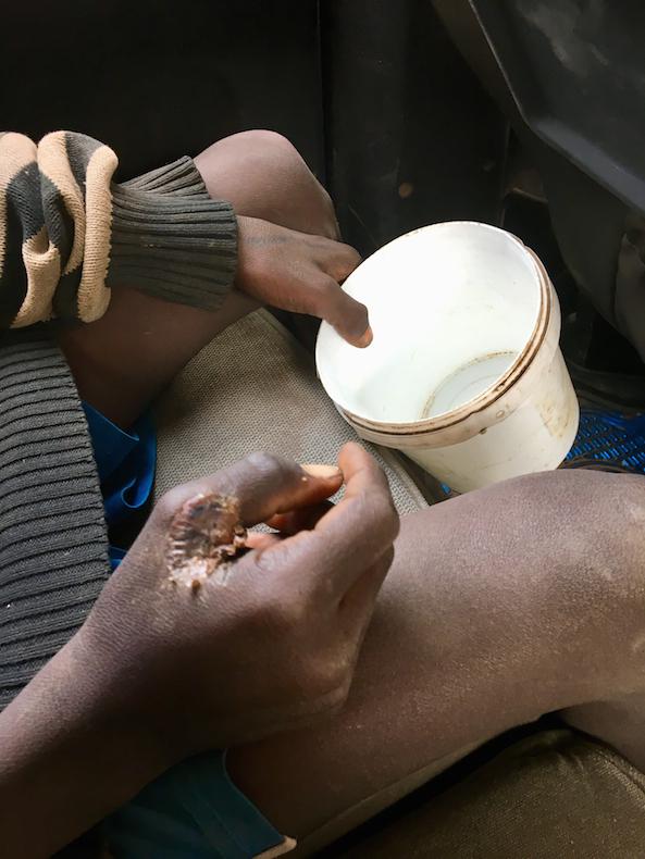 Un talibé présente une blessure non traitée à la main, tenant sa sébile dans l'autre main. Cet enfant, pensionnaire de la même école coranique de Louga que la victime de l'accident de moto du 13 janvier.