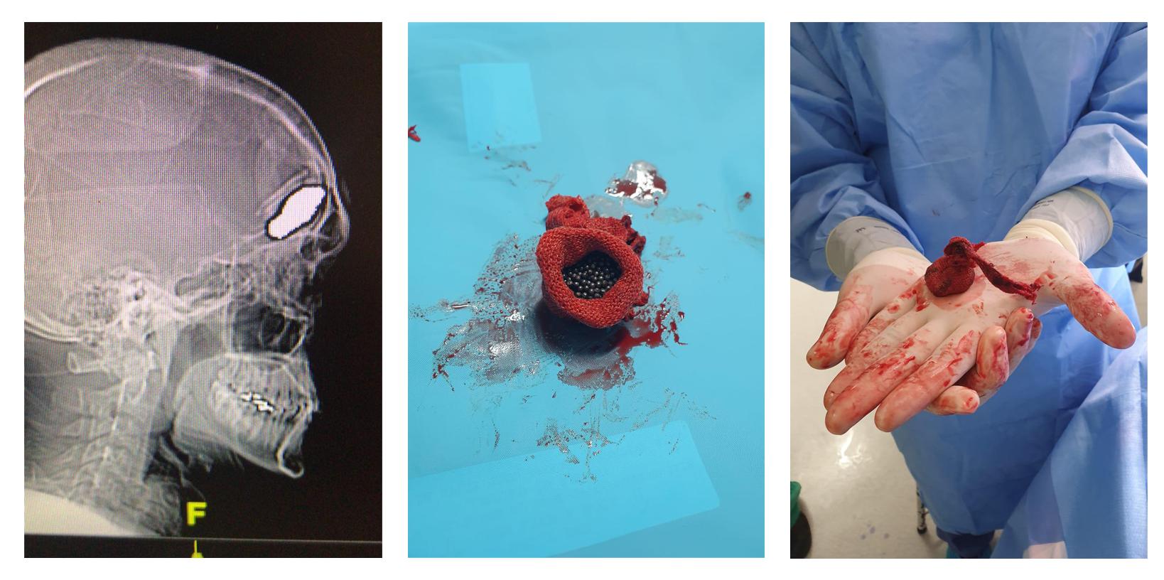 X ray of a patient hit by a bean bag round and images of the round extracted from patient’s skull on October 28, 2019. 