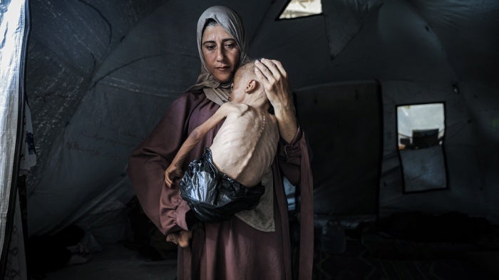 Eighteen-month-old Muhammad Zakariya Ayyoub al-Matouq faces life-threatening malnutrition as the humanitarian situation worsens due to ongoing Israeli attacks and the blockade in Gaza City, Gaza, July 21, 2025. 