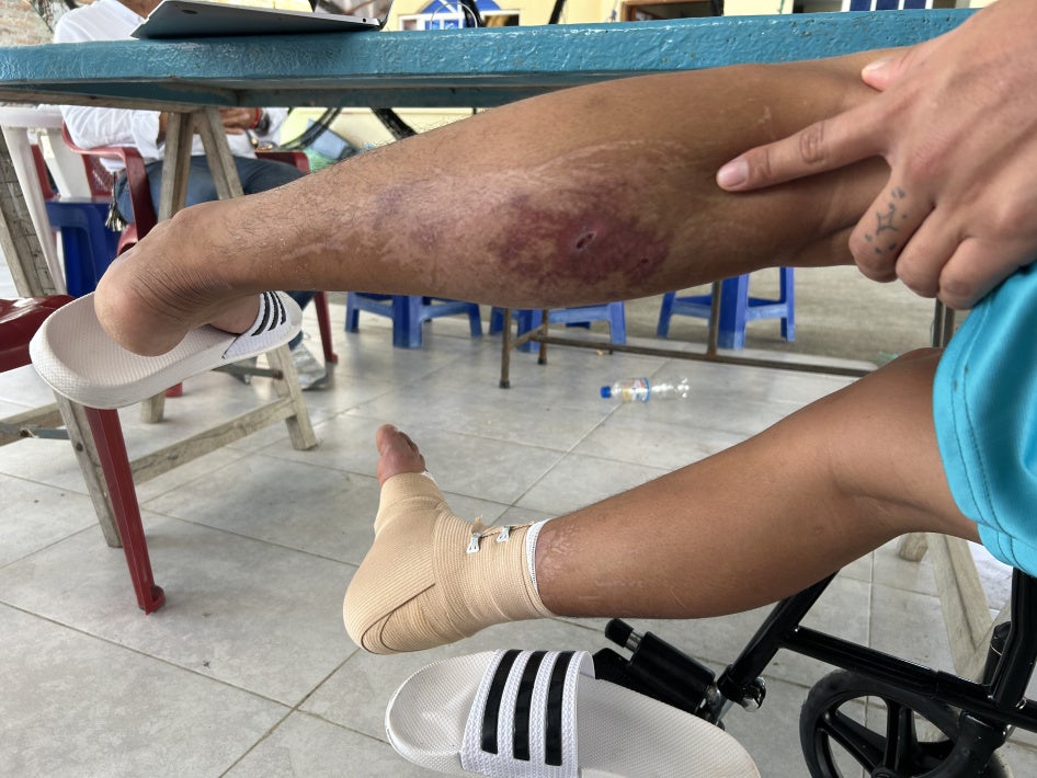 photo of injuries to a leg