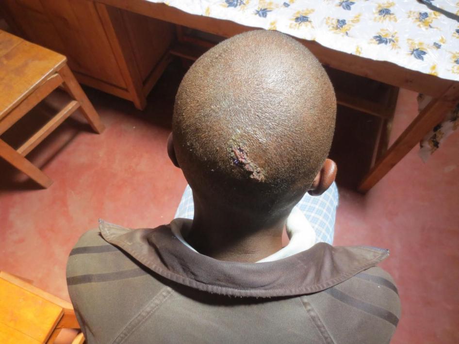 Des Imbonerakure (membres de la ligue des jeunes du parti au pouvoir) ont battu ce jeune homme de 23 ans jusqu’à ce qu’il perde connaissance, le 30 juin 2015, après qu’il a tenté d’intervenir pour aider d’autres personnes en train d’être battues. 